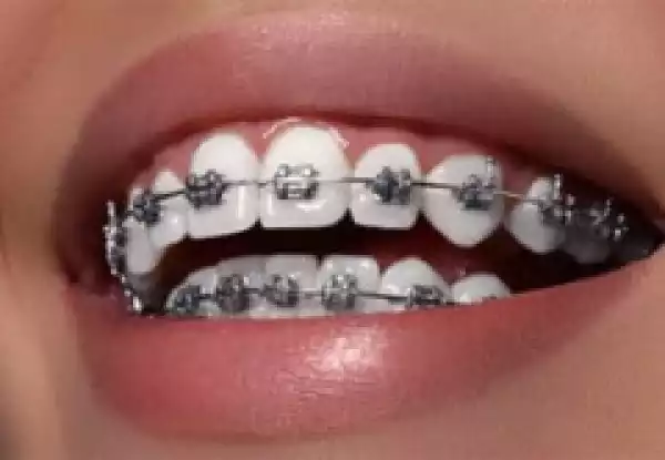 6 Reasons Why You Need Braces
